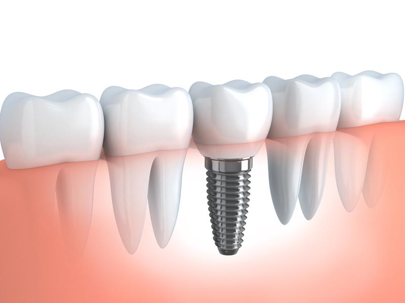 Dental Implants P.O. Box 
